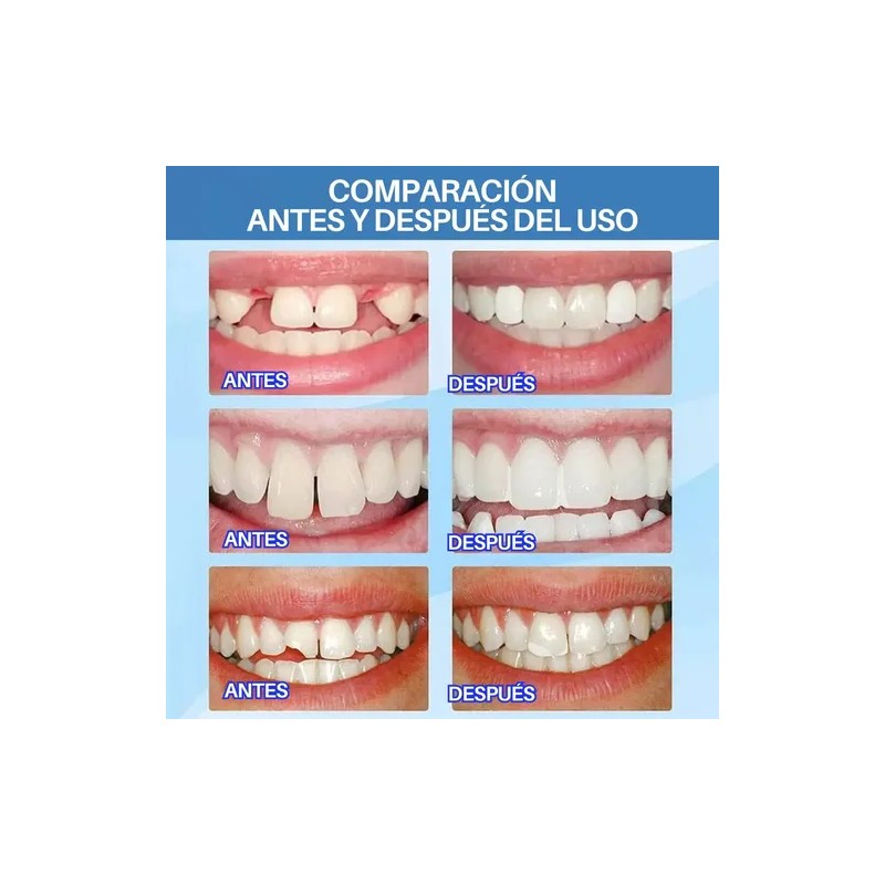 Perlas para Reparación Temporal de Dientes con Resina Moldeable de