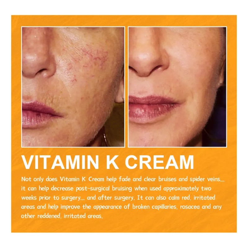 Hla Ye- Crema De Vitamina K Eelhoe Para La Hinchazón