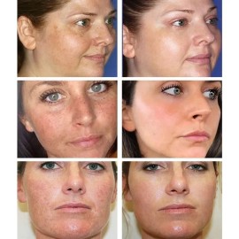 Crema Quitamanchas Hidratante 20g Para Rostro Todo Tipo De Piel Día/noche