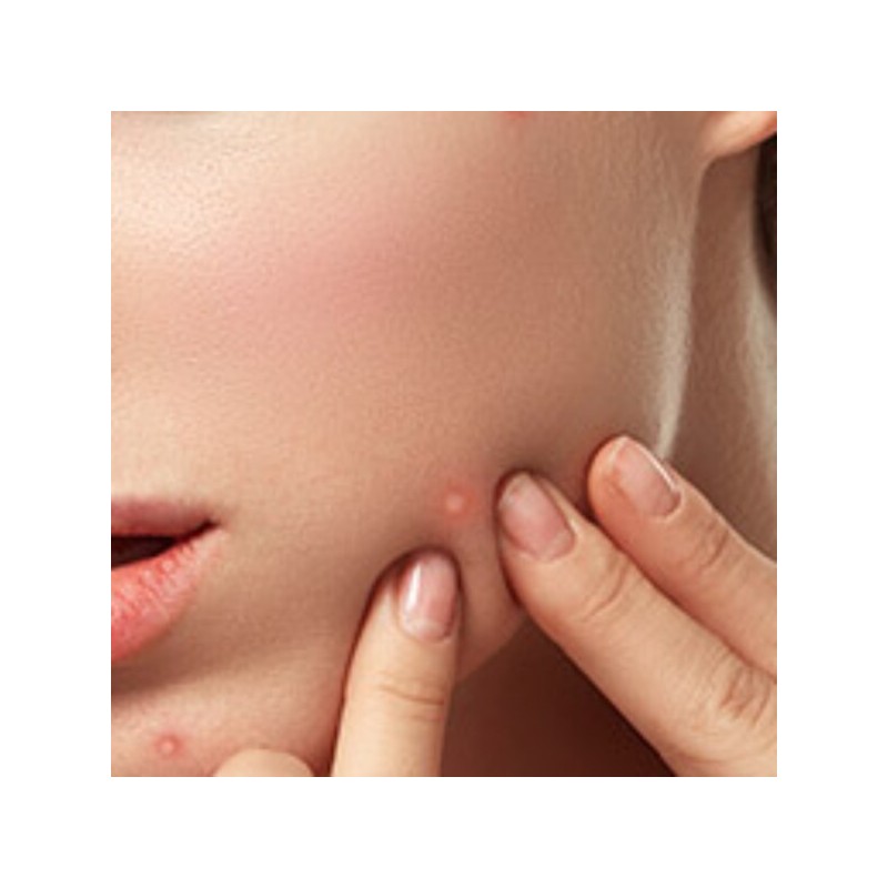 뾰족피지핀셋 초등학생블랙헤드 귀블랙헤드제거 겨드랑이피지제거 Sharp Pimple Tweezers for Elementary School