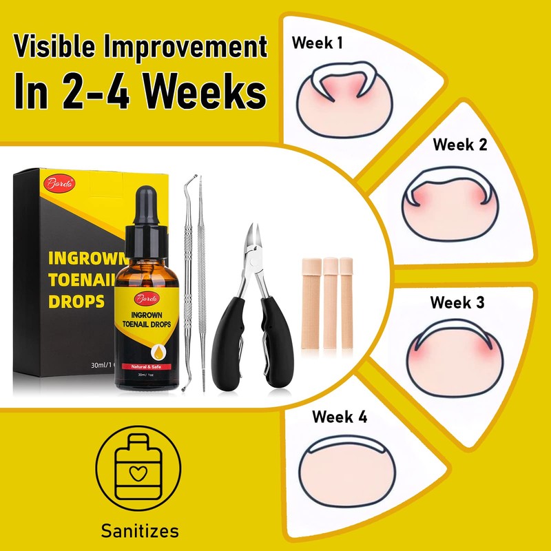 Pjordo Ingrown Toenail Removal Kit - 30ml/1oz Ingrown Toenail Drops