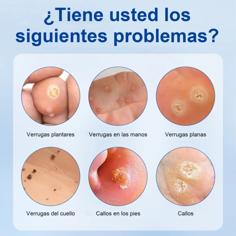 Crema Para Verrugas Elimina Eficazmente Y Cuida La Piel 20g