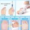 MEMNUN Bunion Corrector Bunion Correction Correction Correction Toe Correction Can