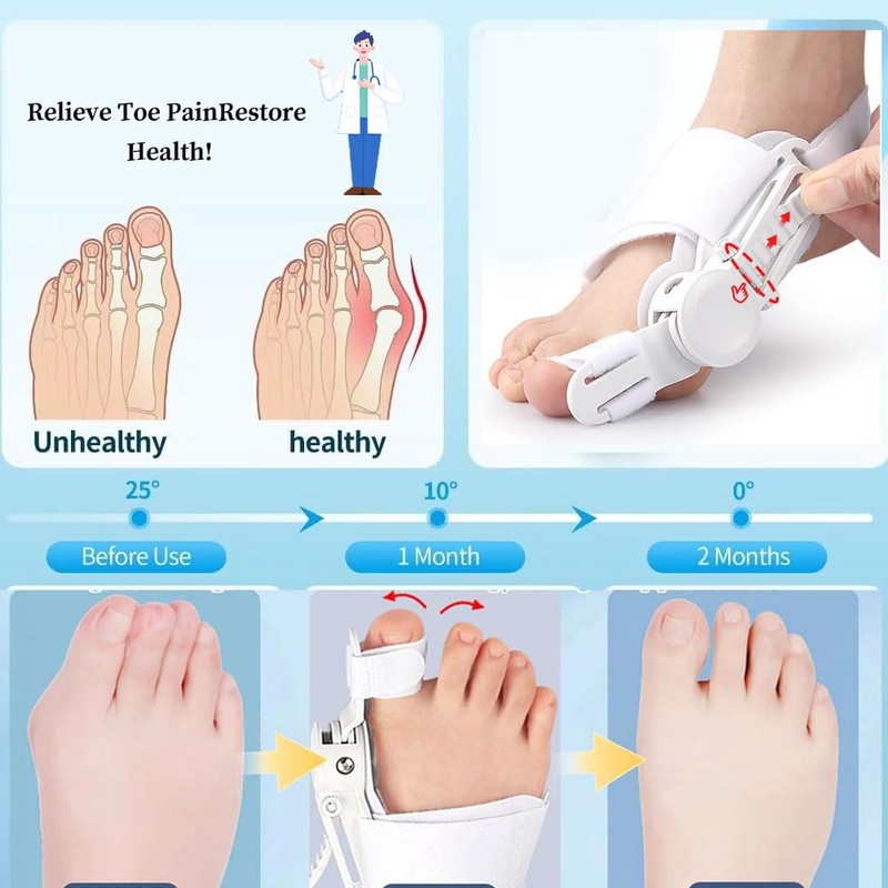MEMNUN Bunion Corrector Bunion Correction Correction Correction Toe Correction Can