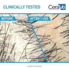 CeraVe Champú hidratante anticaspa, tratamiento de caspa de piritiona y zinc al 1% con ceramidas, niacinamida y ácido hialurónico, ayuda a eliminar la