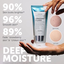 Keratosis Pilaris Treatment | Keratosis Pilaris Lotion | KP Lotion | Gentle Exfoliation For Strawberry Legs, KP & Ingrown Hairs | Smooth & Hydrating Body Lotion For Redness, Dry, Rough And Flaky Skin