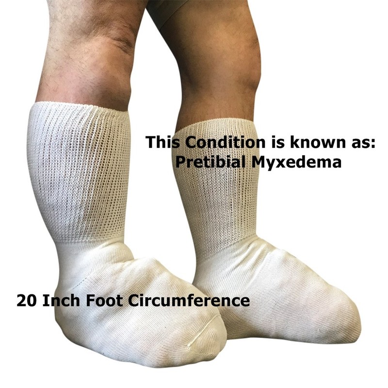 Bariatric Sock for Extreme Lymphedema Calf stretches to 30" (Black)