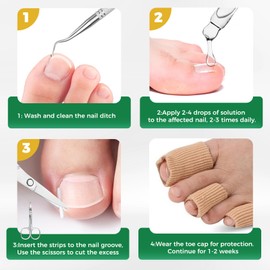 Ingrown Toenail Kit - Ingrown Toenail Drops, Ingrown Toenail Set - 60 Pcs Toenail Straightener Strips -Toenail Lifter Small Scissors