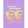Dermalogica Clear Start Breakout Clearing Liquid Peel 30ml