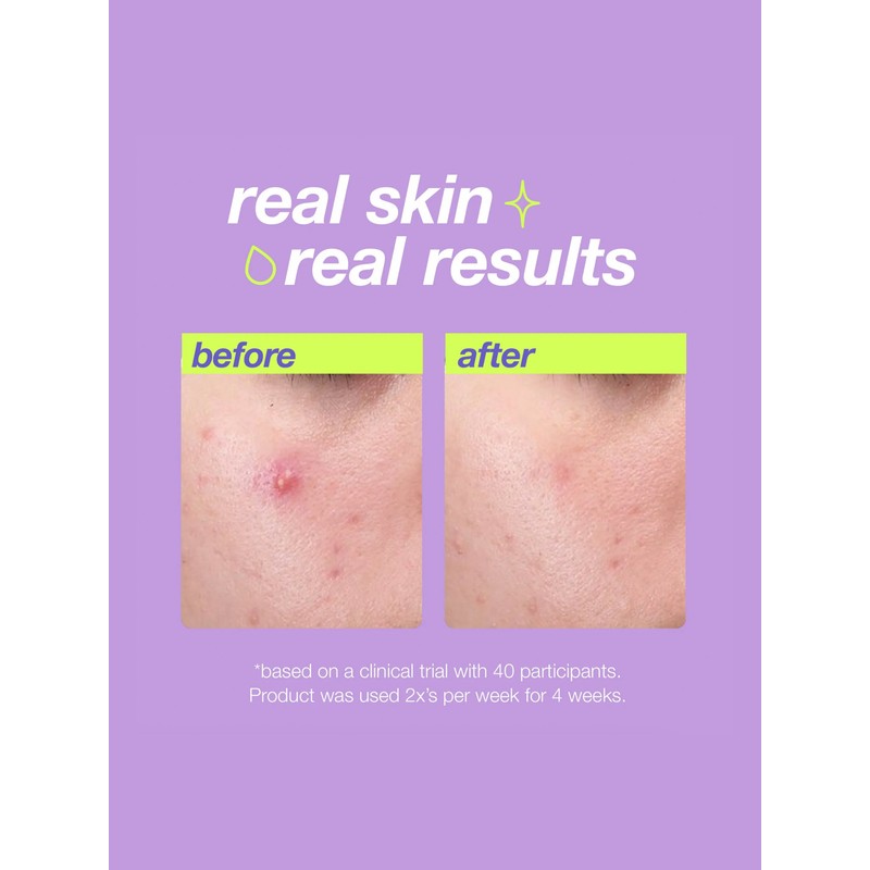 Dermalogica Clear Start Breakout Clearing Liquid Peel 30ml