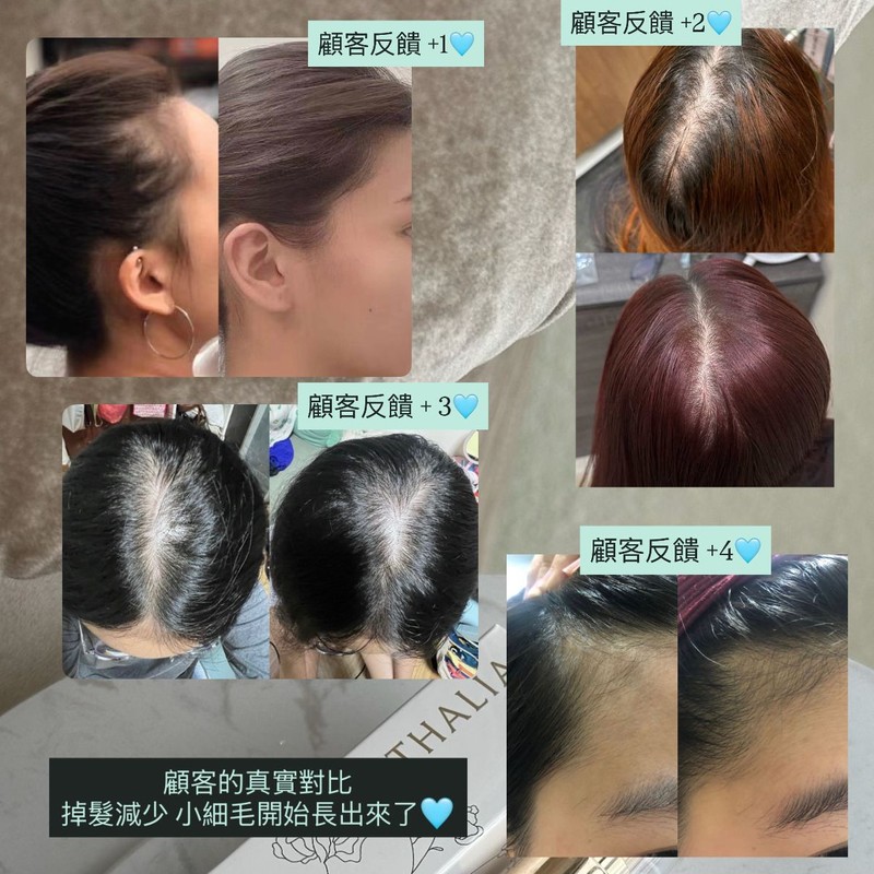 ATHALIA Hair Growth Essence FAST & EFFECTIVE [ Anti-Hair Loss,