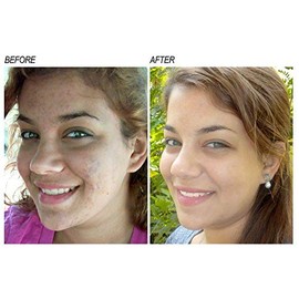 NEOPROSONE  Serum Vitamina C Facial  Tratamiento Despigmentante Aclarante Blanqueador con Vitamina C al 20 y Alfa Arbutina  Hidrata y trata Lineas de 