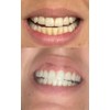 Smile Titan Teeth Whitening Gel Refill 4X Syringes 44% Carbamide