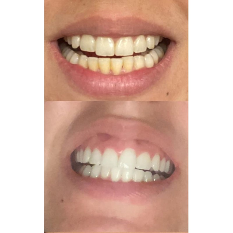Smile Titan Teeth Whitening Gel Refill 4X Syringes 44% Carbamide