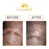 Keloid Removal Removal Duo