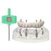 Ningfan Dental Implant Model,Implant All on 4 Overdenture Treatment Model,
