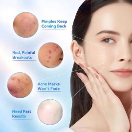 Acido Salicilico Serum Tratamiento Acne Y Barros Marcas Acne
