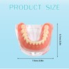 Dental Model Overdenture Transparent Dental Implants Model Detachable Model Lower