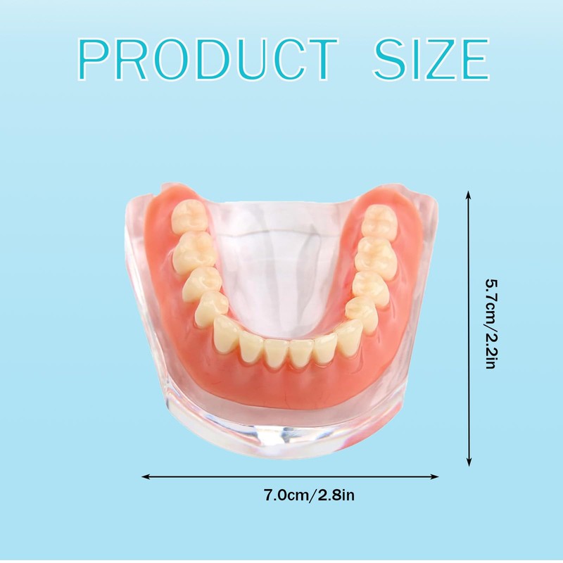 Dental Model Overdenture Transparent Dental Implants Model Detachable Model Lower