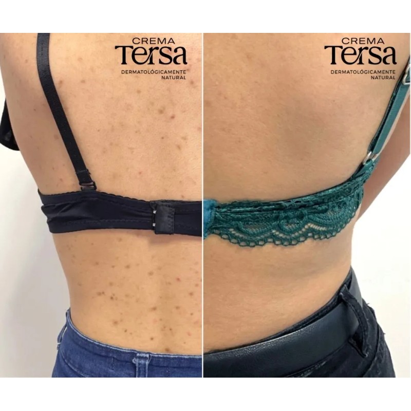 Crema Tersa Despigmentante Quita Manchas Acné Paño De 400g