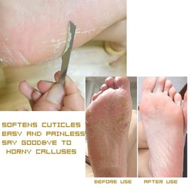 Exfoliating Ingrown Toenail Removal Pedicure Knife,Decorative Foot Knives for Ingrown Callus Shaver Feet Nail Correction Pliers Scissors Corn Remover With Storage Bag (3)