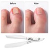 Toenail Trimmer, Toenail Clippers for Thick and Deep Ingrown Toenails