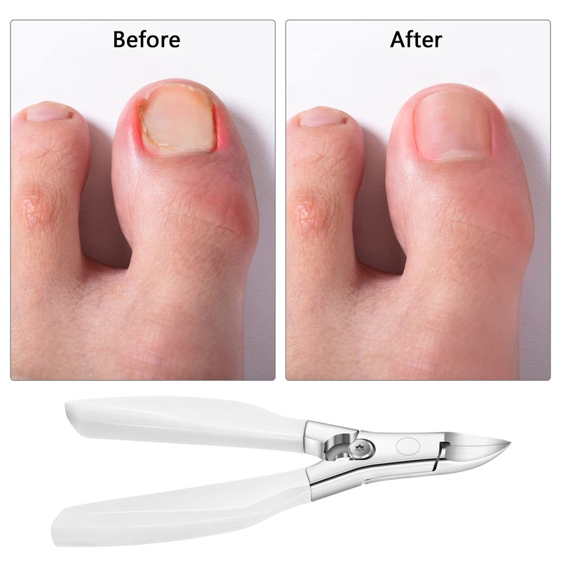 Toenail Trimmer, Toenail Clippers for Thick and Deep Ingrown Toenails