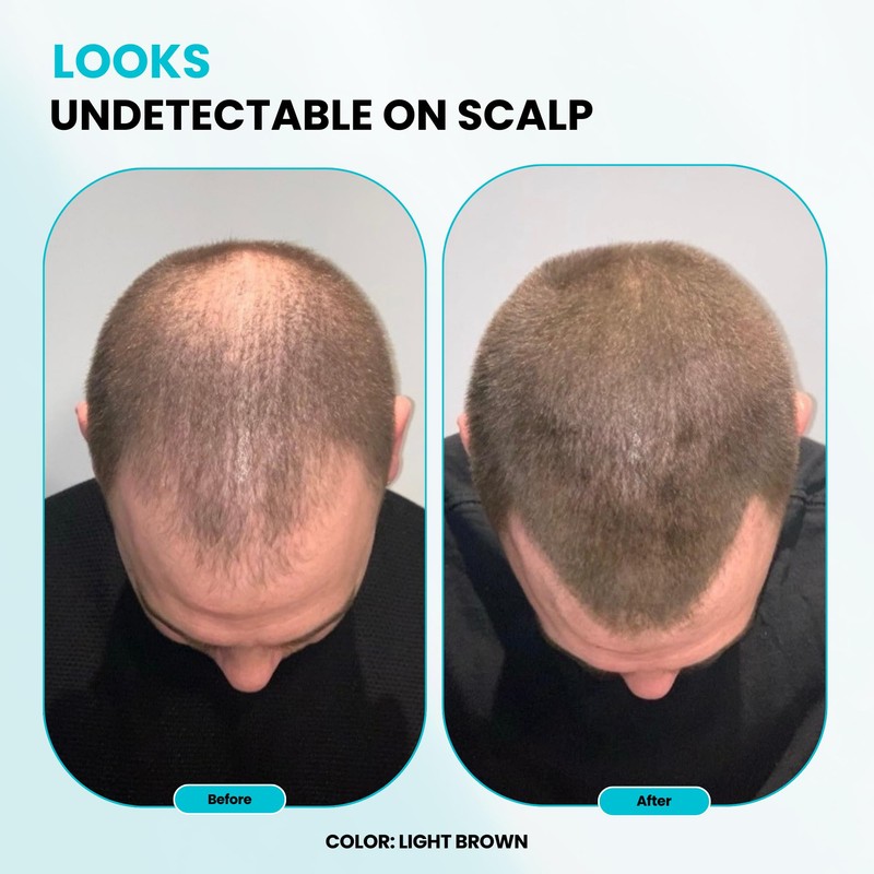 SURETHIK Hair Fibers, 15g (Black), Fills Thinning Hair for Visibly