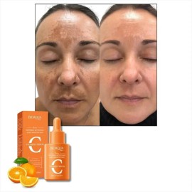 Serum Crema C Elimina Manchas Paño Pecas Aclarante Anti Edad Tipo De Piel Normal