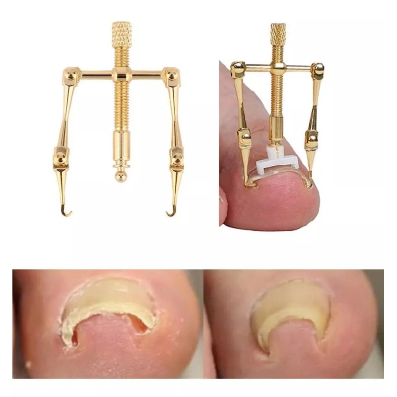 OEM Kit 6 Piezas Herramienta Para Quitar Sanar Uñas Enterradas