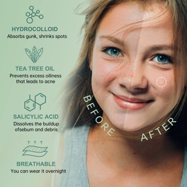 Flossty Hydrocolloid Salicylic Acid Tea Tree Oil Pimple Patches Star Breathable and Waterproof, EU Skin Test Hypoallergenic, Pack of 156