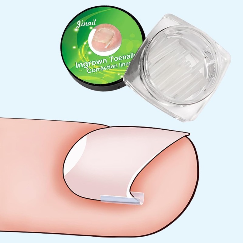 10 Pcs Ingrown Toenail Correction Strips Brace Kit, Ingrown Toenail