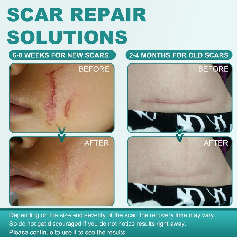 Silicone Scar Sheets, Silicone Scar Tape(1.6"x 158"), Scar Tape for