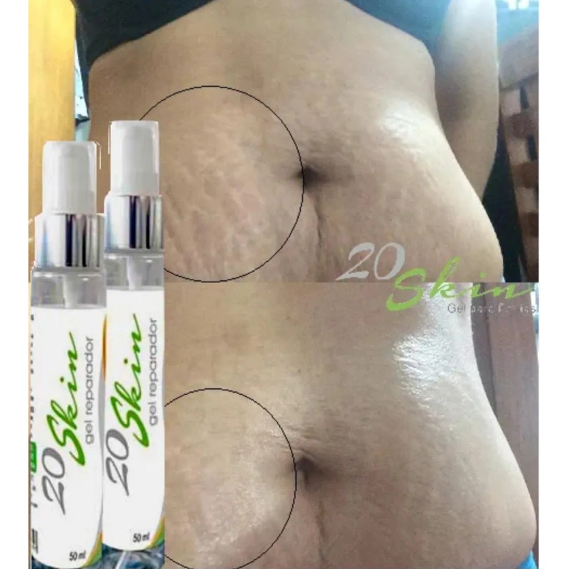 20skin Gel Para Estrías 50ml Para Todo Tipo De Estrias