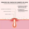 JING DUODUO Parches para Acne 200PCS Pimple Patch, Parches para