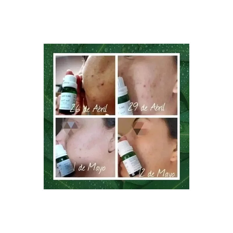 Tonico/sérum/jabón Tea Tree/control Acné/grasa/farmasi