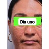 Crema Despigmentante Aclara Piel Acné Manchas Paño Melasma