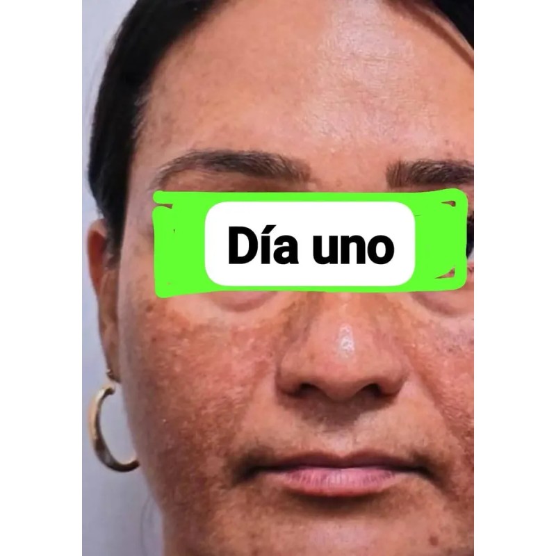Crema Despigmentante Aclara Piel Acné Manchas Paño Melasma