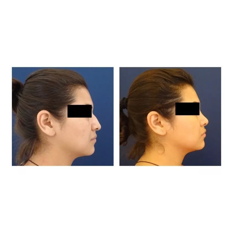 Nose Up Respingador Corrector Nariz Endereza Levanta Perfila Eficaz