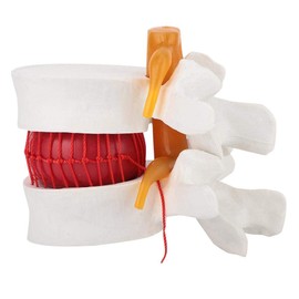 LiebeWH Plastic Human Herniated Disc Medical Demonstration Model, 1:1.5 Model of Human Lumbar Disc Model for Linear Teaching