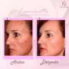 4pack Crema Facial & Corporal Luminatte Aclaradora, Melasma.