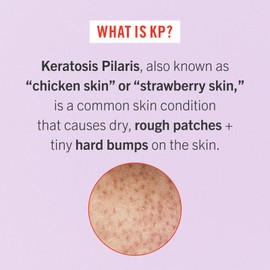 First Aid Beauty - Smooth Operators Trio: KP Bump Eraser Body Scrub, 8 oz, Smoothing Lotion, 6oz, and Ingrown Hair Pads, 28 Pads, Deep Moisture Exfoliating Skin Treatment Set with BHA & AHA, 3ct