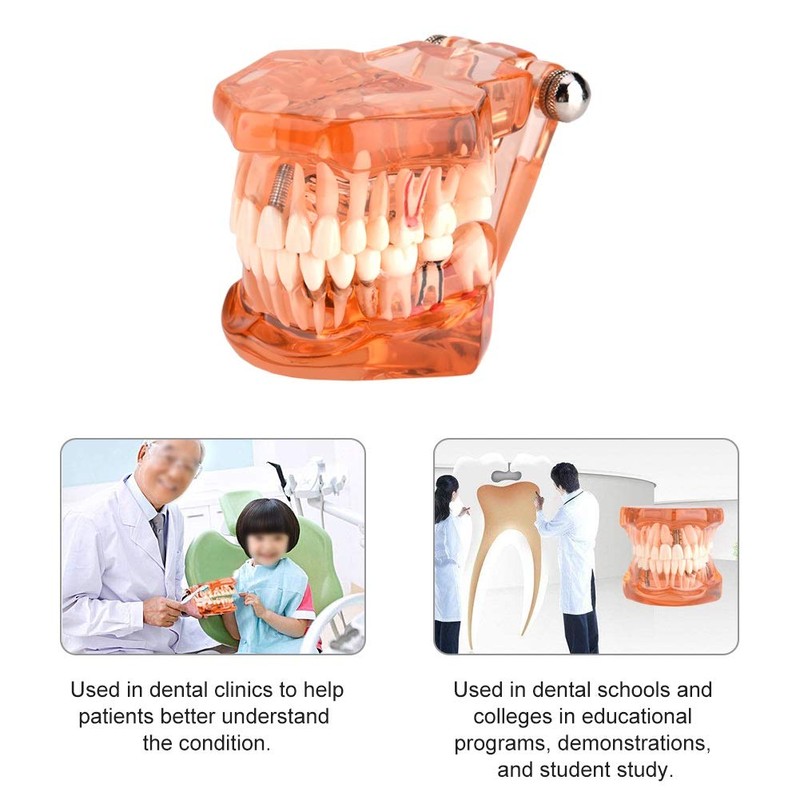 Dental Model Dental Model, Removable Dental Implant Teaching Model Dentist
