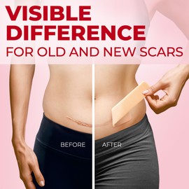 Medical Grade Silicone Scar Sheets - 6pk (7”x1.6”) - Visible Difference on C-Section Scars - Reusable Scar Strips - Easy to Use Patches for Scar Healing