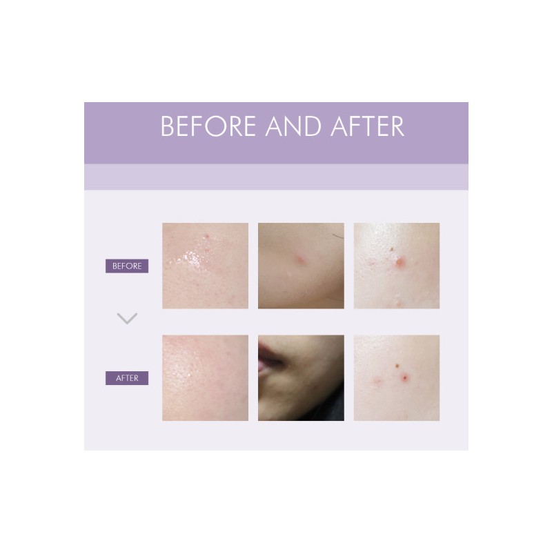 ANACIS Acleon Advanced Blemish Spot Concentrate 30ml