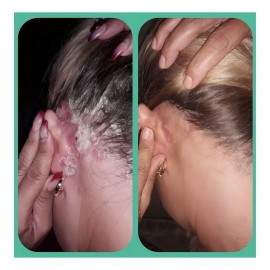 Shampoo Alquitran De Hulla Shampoo Control Psoriasis Y Caspa