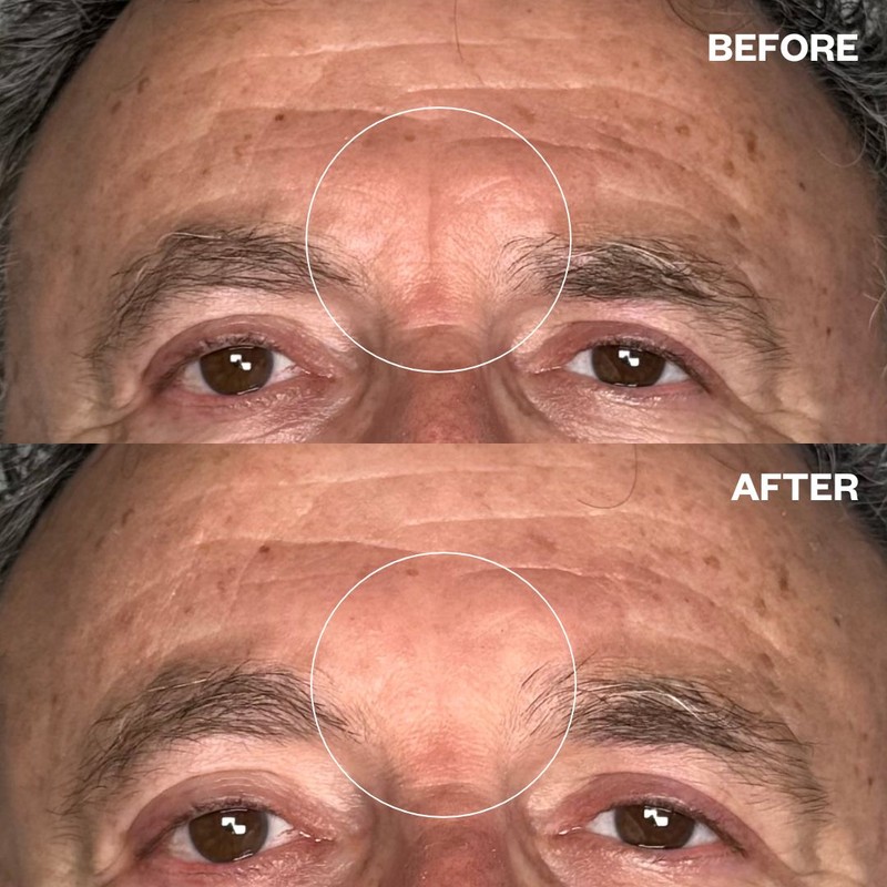 Wrinkles Schminkles Men's Pro Forehead Wrinkle Patches - 2 Patches