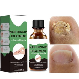 Fungal Nail Treatmet for Toenail - Extra Strong Nail Fungas Treatmet for Toenail and Fingernail, Fix and Renew Damaged, Broken Nails - Restoring Healthy Nails - 30ml