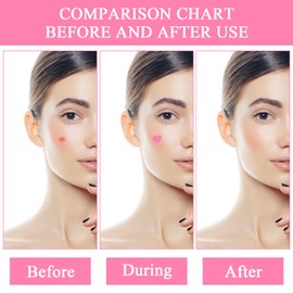 Xzeemo Pack of 54 Pimple Patches, Universal Acne Pimple Patch, Hydrocolloid Acne Sticker, Pimple Plaster for Face Anti Acne Skin Treatment, Two Sizes 10 mm, 15 mm (Pink Heart Shape)