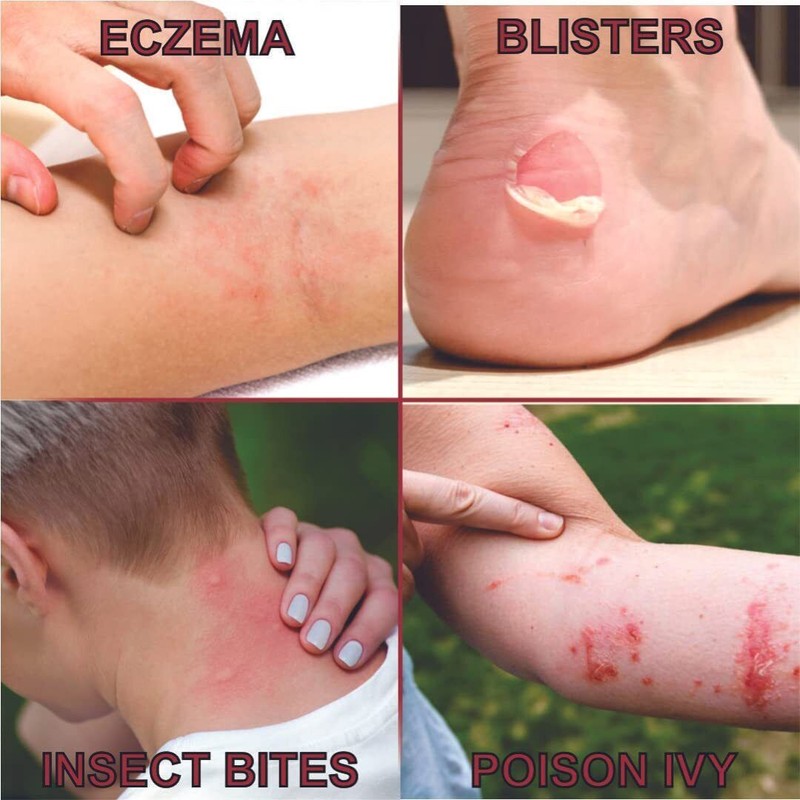 QUATRIDERM Fast Relief Hydrocortisone Cream for Eczema Itch Inflammation Aloe
